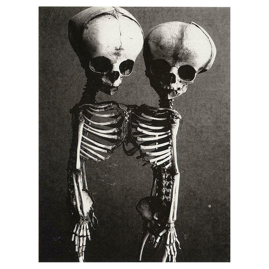 Conjoined Twins, Skeletons